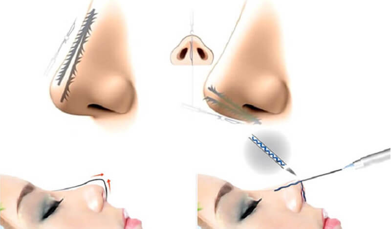 Nâng mũi không phẫu thuật chỉ áp dụng cho trường hợp mũi không quá thấp